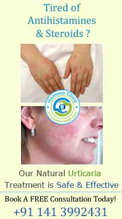 homoeopathic treatment for Urticaria